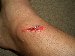 I had to crash my mountain bike. After receiving this wound I had to splash some water on it and take a nap.